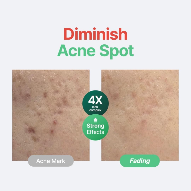 Before-and-after skin photos showing acne fading, with headline 'Diminish Acne Spot' and labels 'Acne Mark' and 'Fading'.