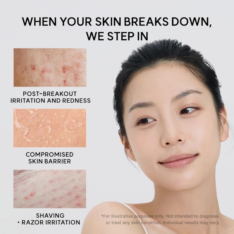 Infographic with a woman on the right and three close-up skin condition images on the left labeled 'Post-breakout irritation and redness', 'Compromised skin barrier', and 'Shaving / razor irritation', plus the headline 'When your skin breaks down, we step in'.