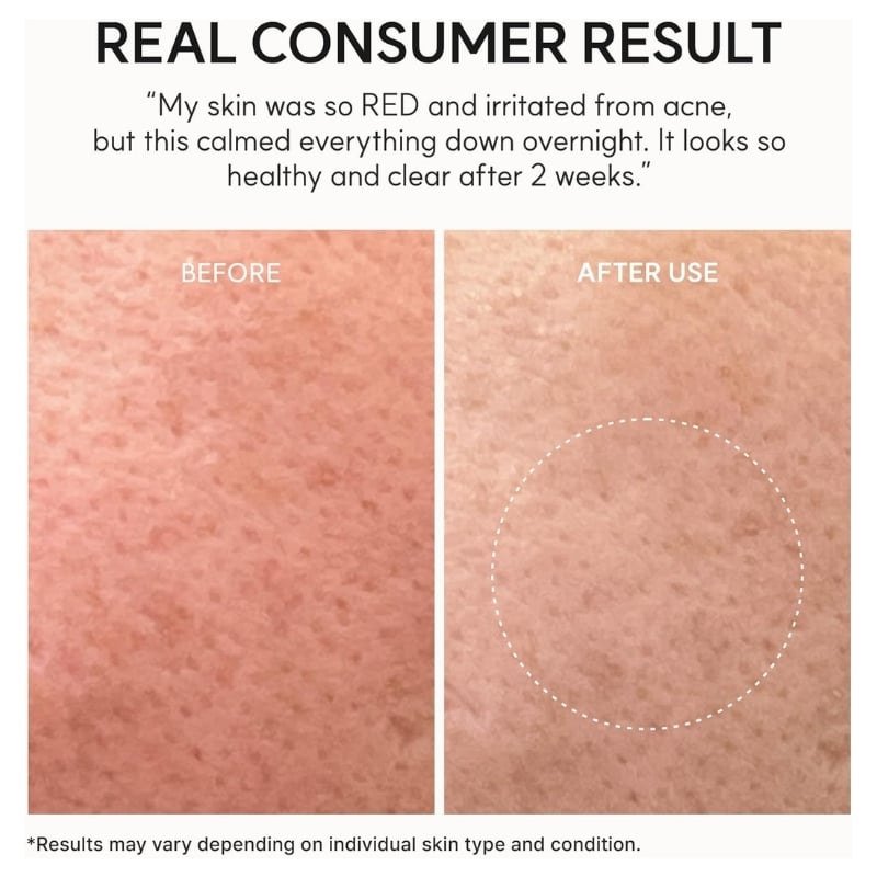 Side-by-side closeups of facial skin labeled BEFORE USE and AFTER USE; left shows red, blemished skin, right shows clearer skin with a circular highlight.
