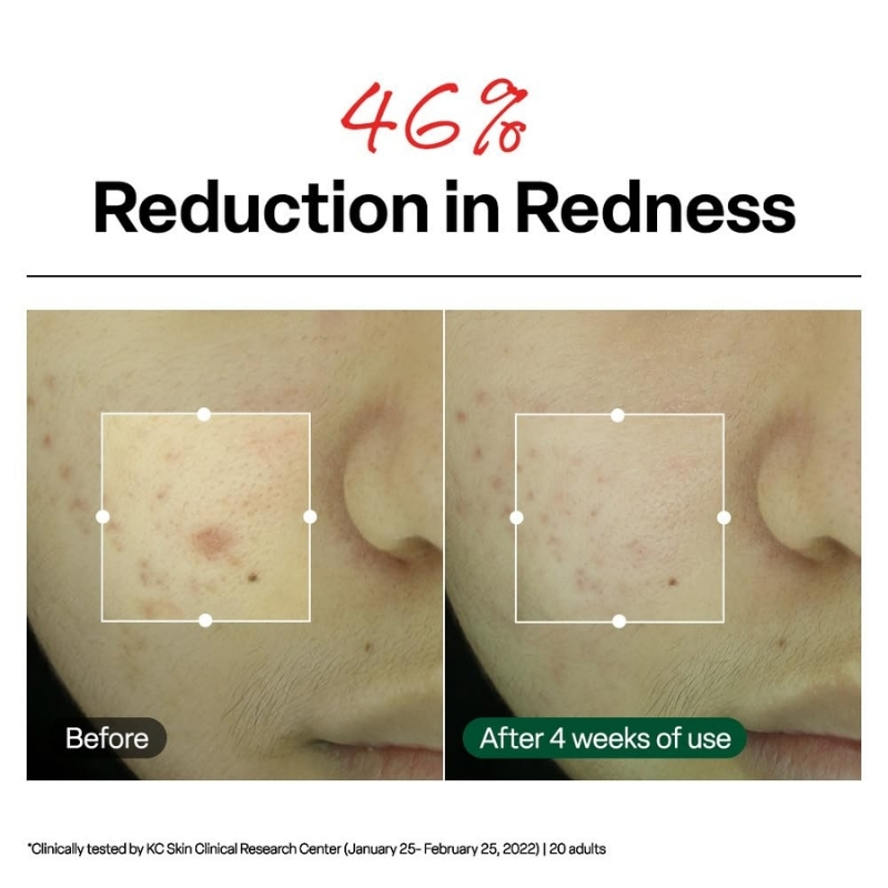 R.E.D Blemish Clear Soothing Cream (70ml) - Image 5
